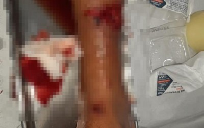 Ciclista sofre corte profundo na perna; motociclista foge e é encontrado na UPA