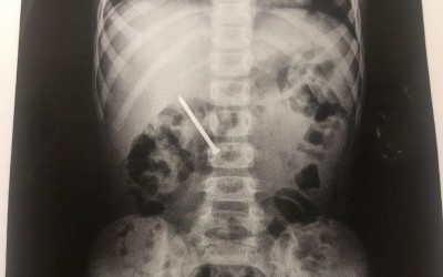 Bebê de 11 meses que engoliu prego é resgatado com vida pelo Corpo de Bombeiros