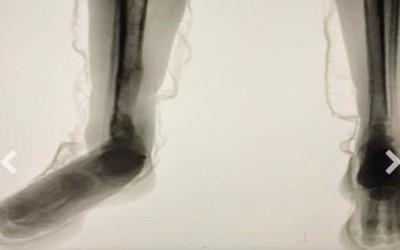 “Body Scan” entrega plano de interno: raio-X flagra cocaína escondida em tênis