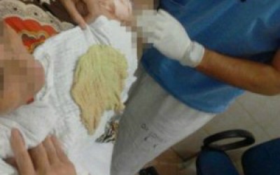Meses depois de cirurgia, filha descobre pano esquecido em barriga de mãe