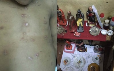 Menino fica desfigurado após ser usado em ritual de magia negra pela própria família