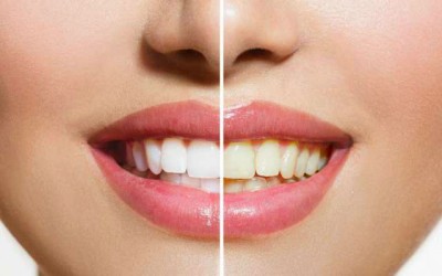 7 alimentos que escurecem os dentes