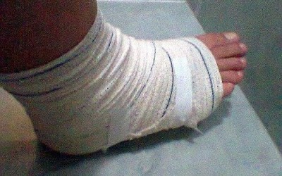 Jovem pisa em “bombinha” em parque de exposições e sofre corte profundo no pé