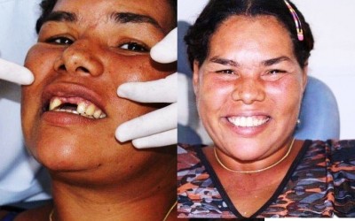 Três-lagoense que ganhou dia de princesa recebe doação de implantes e volta a sorrir 