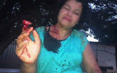 Além de ter o dedo decepado, mulher é esfaqueada no pescoço e nas costas 