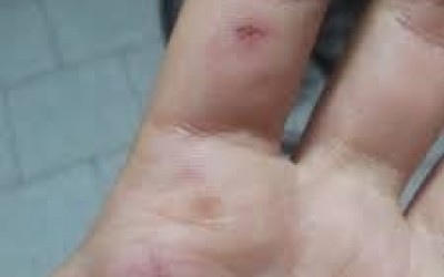 Após pular o portão de residência, cachorro ataca e morde moradora do bairro Santa Rita 