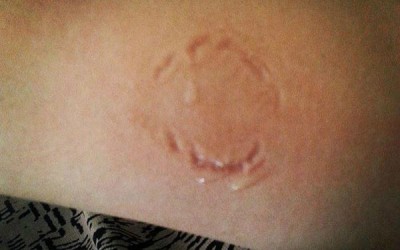 Após ser agredida e mordida no braço, mulher 