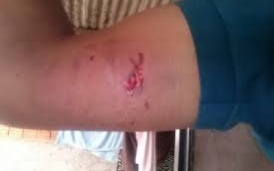 Funcionário de metalúrgica é atacado por Pit Bull