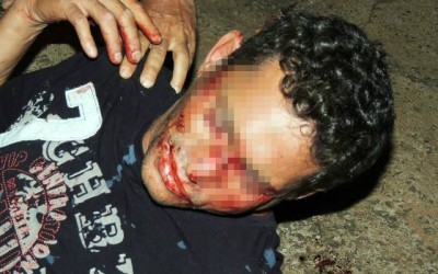 Briga em bar deixa cliente com suposta fratura no nariz 