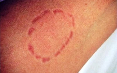 Ladrão morde braço de adolescente para roubar celular