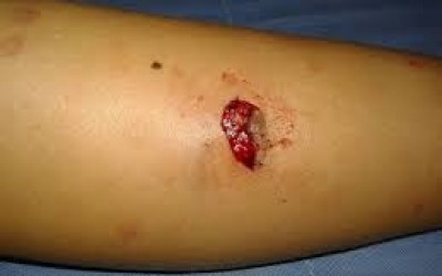 Ataque de cachorros faz com que criança quebre a perna no bairro Vila Haro