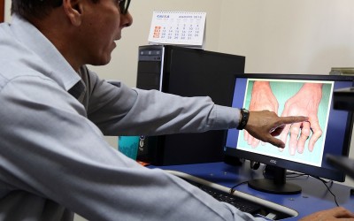 Três Lagoas tem um caso confirmado de febre Chikungunya