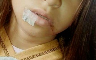 Menina de 10 anos fica ferida por linha de pipa em Três Lagoas 