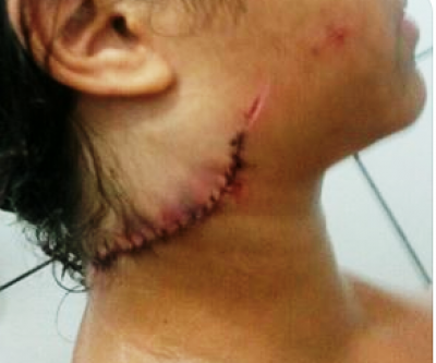 Estudante tem pescoço cortado por linha de cerol quando trafegava em motocicleta