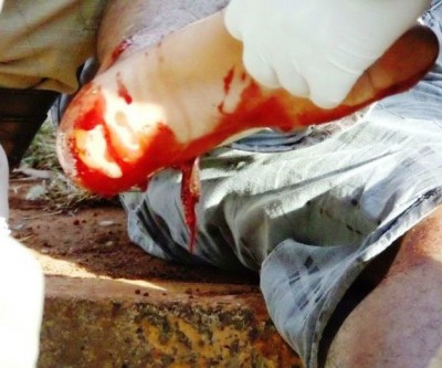 Homem sofre fratura exposta grave ao cair com motocicleta