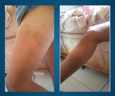 Criança de 9 anos é espancada com corrente de bicicleta depois de brigar com irmã