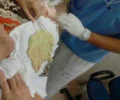 Meses depois de cirurgia, filha descobre pano esquecido em barriga de mãe