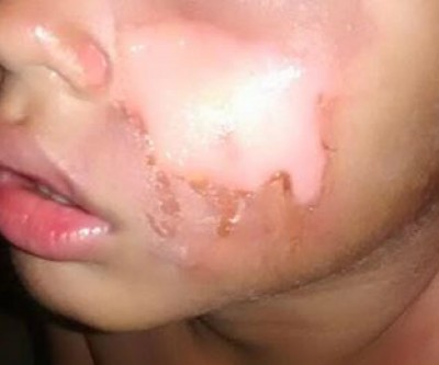 Criança de 05 anos pede comida à mãe que joga feijão quente no rosto do filho 
