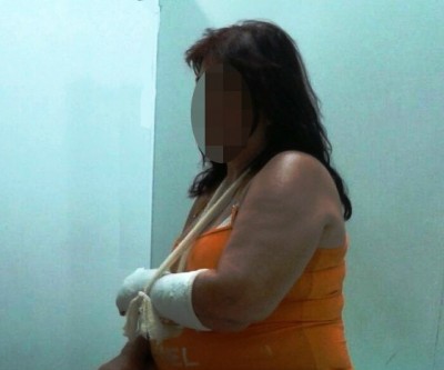 Mulher tem braço quebrado por marido durante briga