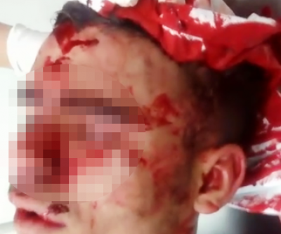 Assaltante atacado por Pitbull e espancado por reféns será transferido para Campo Grande 