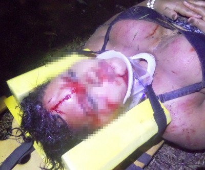  Jovem desequilibra moto em poça d’água e ao cair, sofre ferimentos na face 
