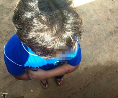 Criança de 11 anos atacada por cachorro é resgatada pelo SAMU 