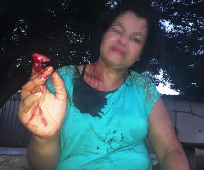 Além de ter o dedo decepado, mulher é esfaqueada no pescoço e nas costas 
