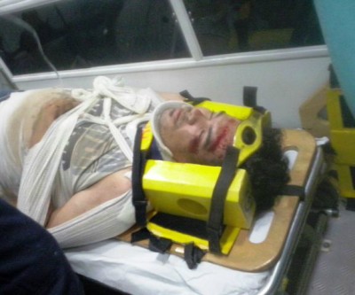 Universitário de 22 anos quebra clavícula ao passar em buraco 