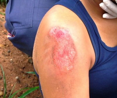 Mulher fica ferida em acidente entre motos no São João