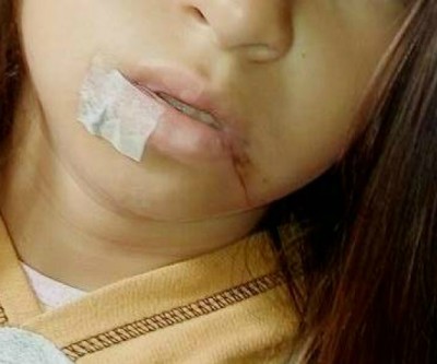 Menina de 10 anos fica ferida por linha de pipa em Três Lagoas 