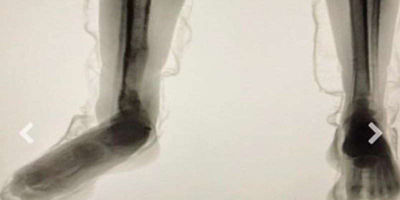 “Body Scan” entrega plano de interno: raio-X flagra cocaína escondida em tênis