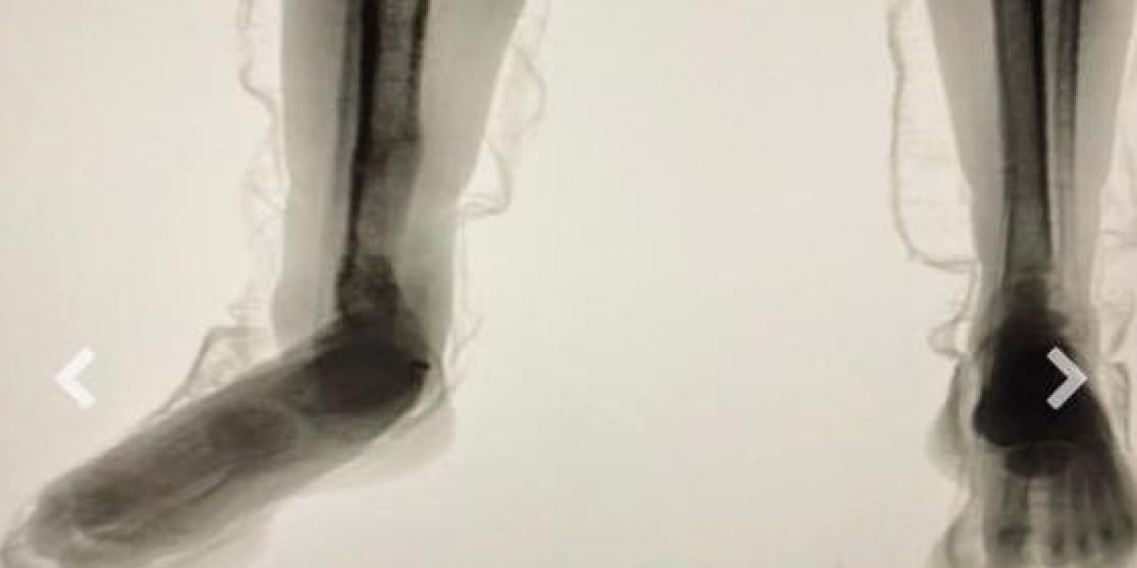 “Body Scan” entrega plano de interno: raio-X flagra cocaína escondida em tênis