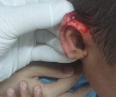 Menino de 3 anos tem orelha cortada com tesoura por colega dentro de escola