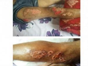 Justiça manda Prefeitura indenizar em R$ 6 mil motociclista que caiu em buraco