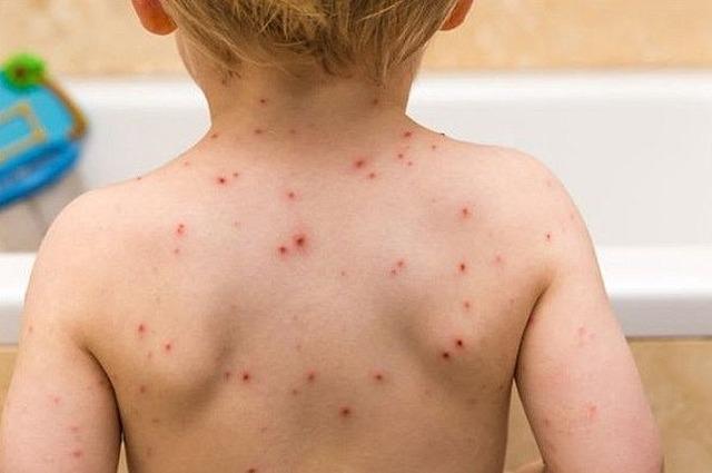 Saúde intensifica vacinação contra o Sarampo nas Unidades Básicas de Saúde de Três Lagoas