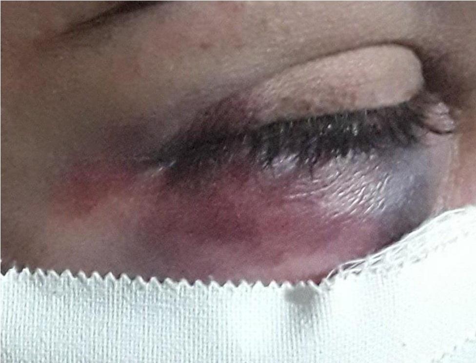 Mulher tem rosto desfigurado pelo marido neste final de semana em Chapadão do Sul