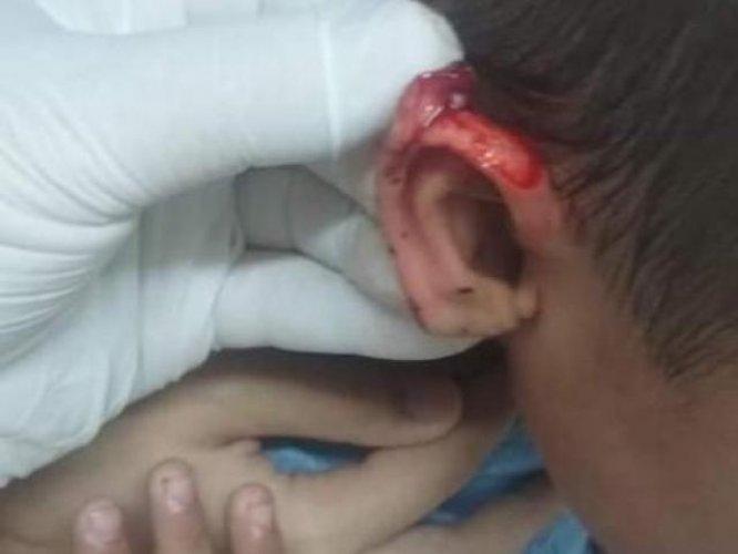 Menino de 3 anos tem orelha cortada com tesoura por colega dentro de escola Menino de 3 anos tem orelha cortada com tesoura por colega dentro de escola