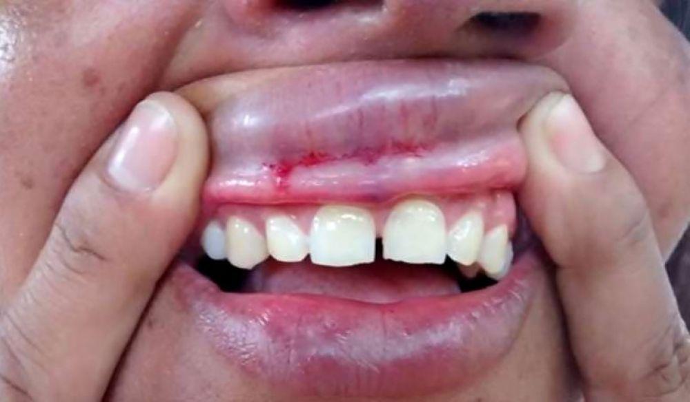 Mesmo usando pedaço de pau para se proteger, mulher é agredida em Três Lagoas 