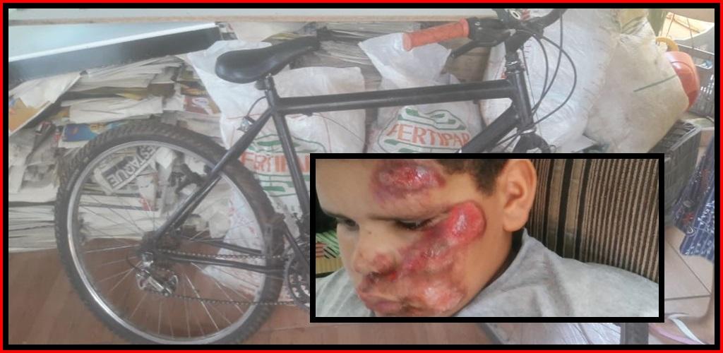 Criança de 9 anos perde dente e fere o rosto ao cair em buraco na rua de Guaraçaí-SP