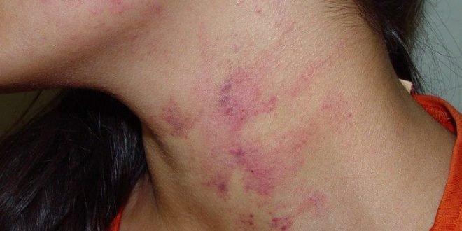 Casada conhece ‘crush’ no Facebook e acaba espancada dentro do motel no 1º encontro