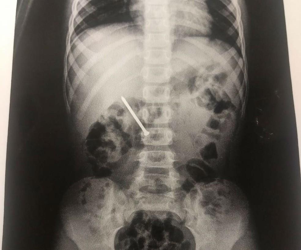 Bebê de 11 meses que engoliu prego é resgatado com vida pelo Corpo de Bombeiros