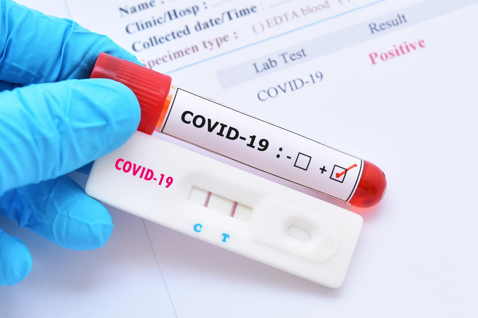 Covid-19: Saúde registra 109 novos casos positivos e 93 recuperados nesta terça-feira Covid-19: Saúde registra 109 novos casos positivos e 93 recuperados nesta terça-feira