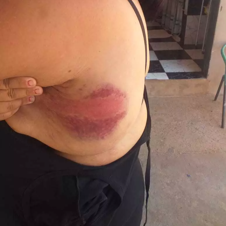 Balconista é agredida a pauladas até desmaiar após “puxar ficha” de companheiro Balconista é agredida a pauladas até desmaiar após “puxar ficha” de companheiro