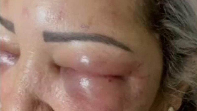 Após procedimento estético na fronteira de MS, mulher tem rosto desfigurado