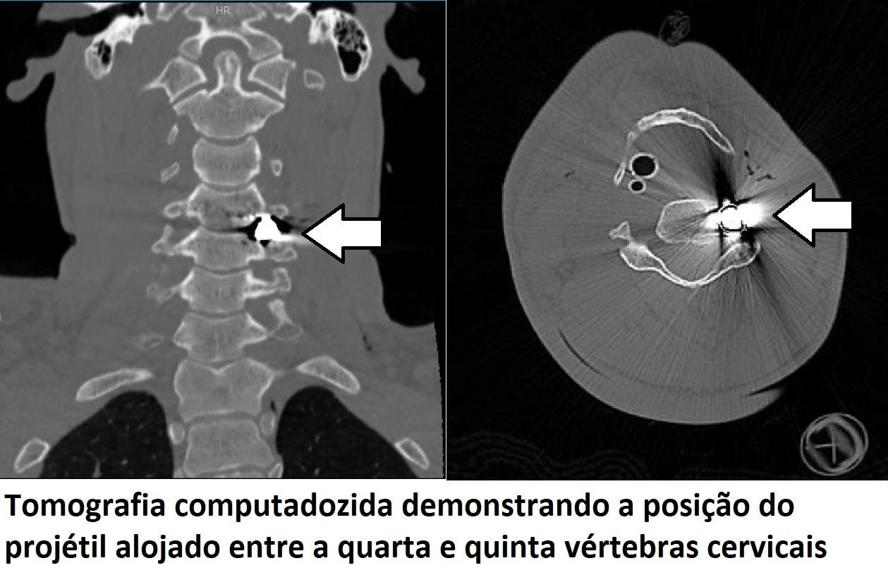 ‘Um milagre meu filho estar vivo’, diz mãe de jovem atingido por tiro no rosto nas Moreninhas