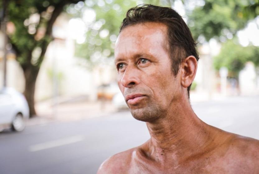Com 70% do corpo queimado, João vende balas na Mato Grosso para comer e pagar remédios