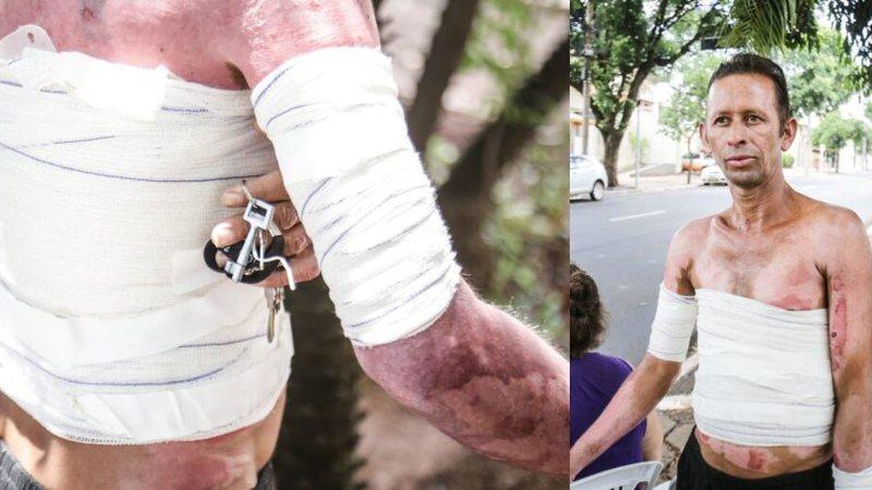 Com 70% do corpo queimado, João vende balas na Mato Grosso para comer e pagar remédios