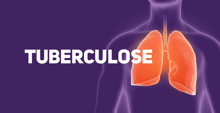 No Dia Mundial de Luta contra a Tuberculose, SMS faz alerta sobre doença que ainda circula em Três Lagoas No Dia Mundial de Luta contra a Tuberculose, SMS faz alerta sobre doença que ainda circula em Três Lagoas
