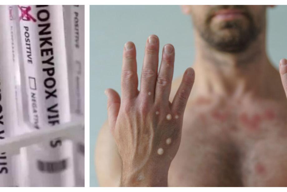 MS volta a registrar casos de monkeypox e acende alerta para cuidados no Carnaval MS volta a registrar casos de monkeypox e acende alerta para cuidados no Carnaval