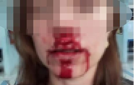 Filho questionado pela mãe sobre horário de alimentação se irrita e quebra o nariz da própria mãe no Nossa Senhora Aparecida 